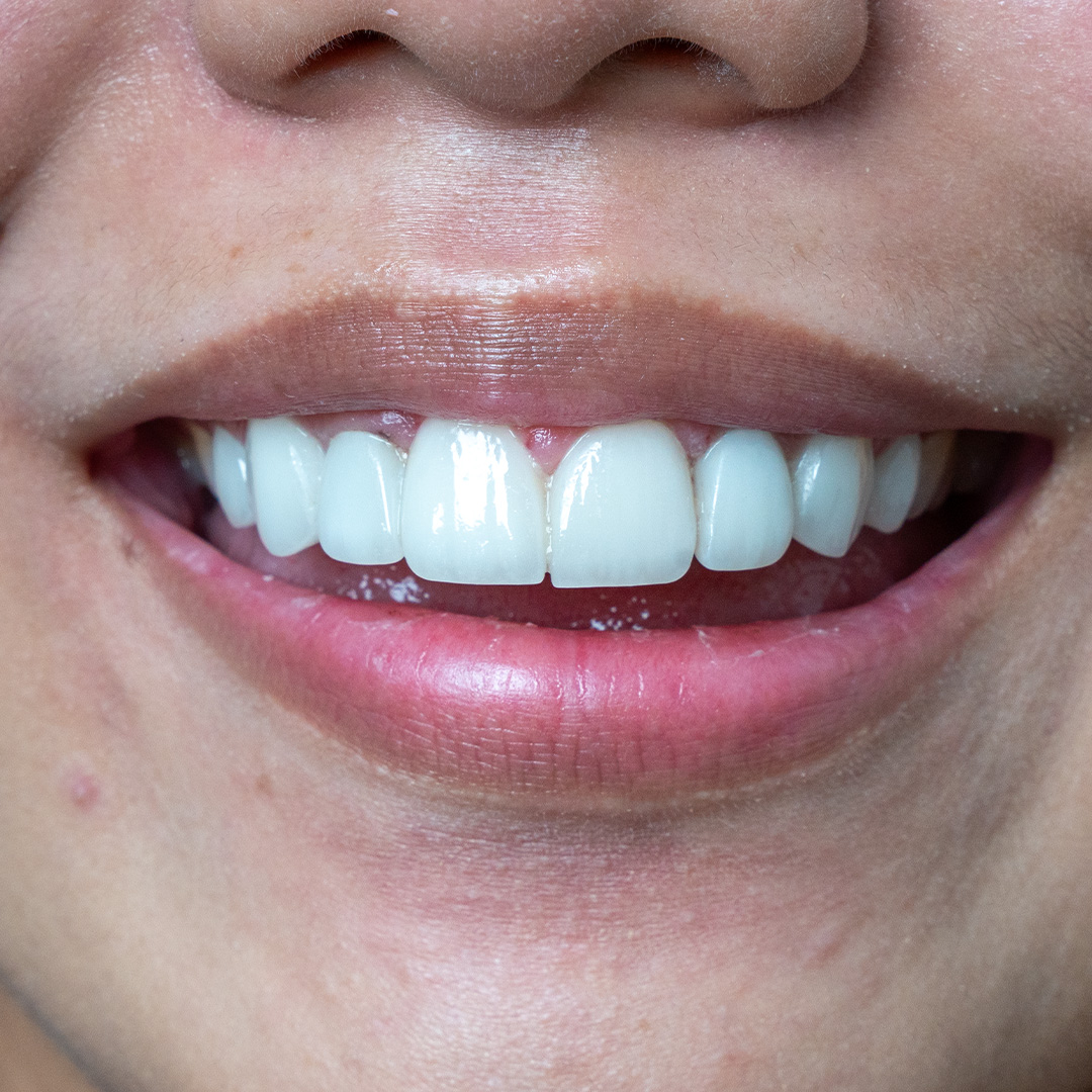 Close-up of natural-looking dental veneers by Vega Medical Center