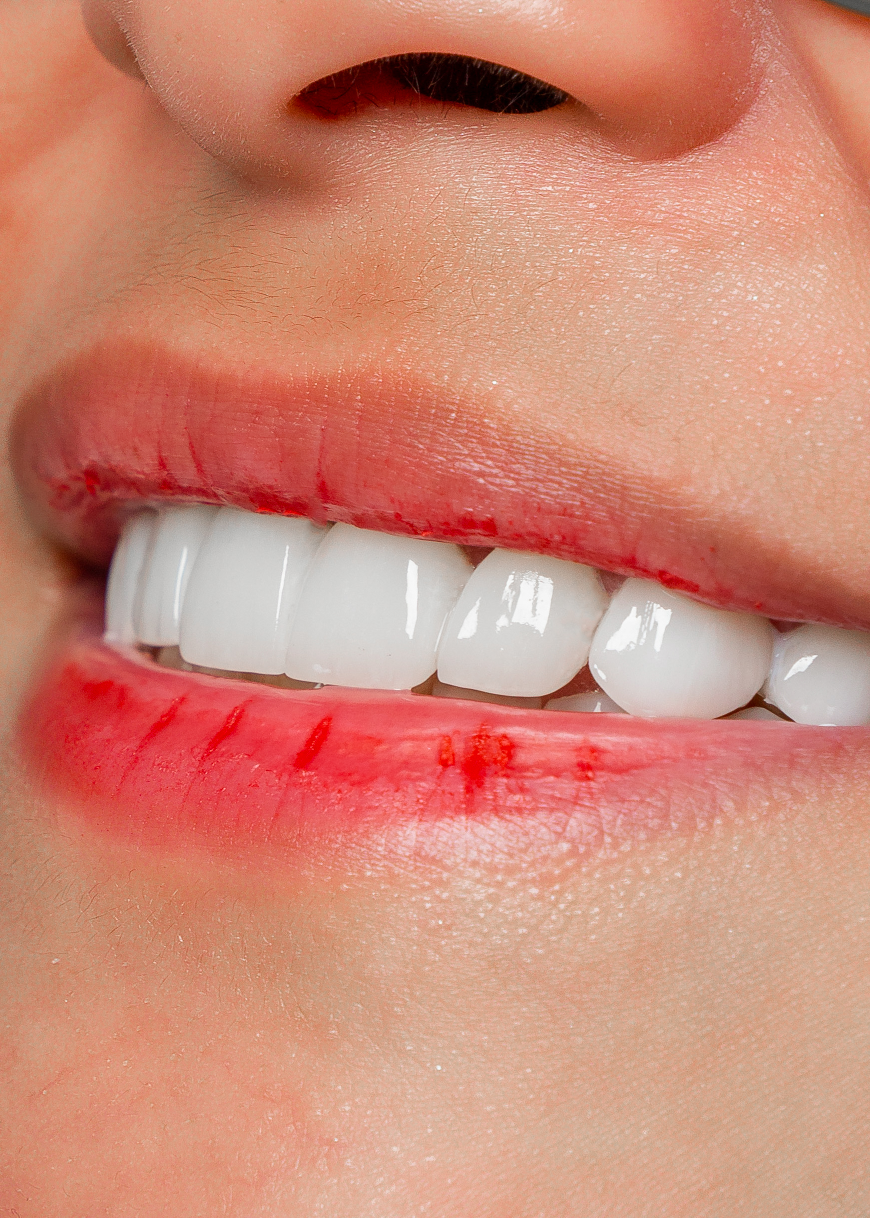 Close-up of natural-looking dental veneers by Vega Medical Center