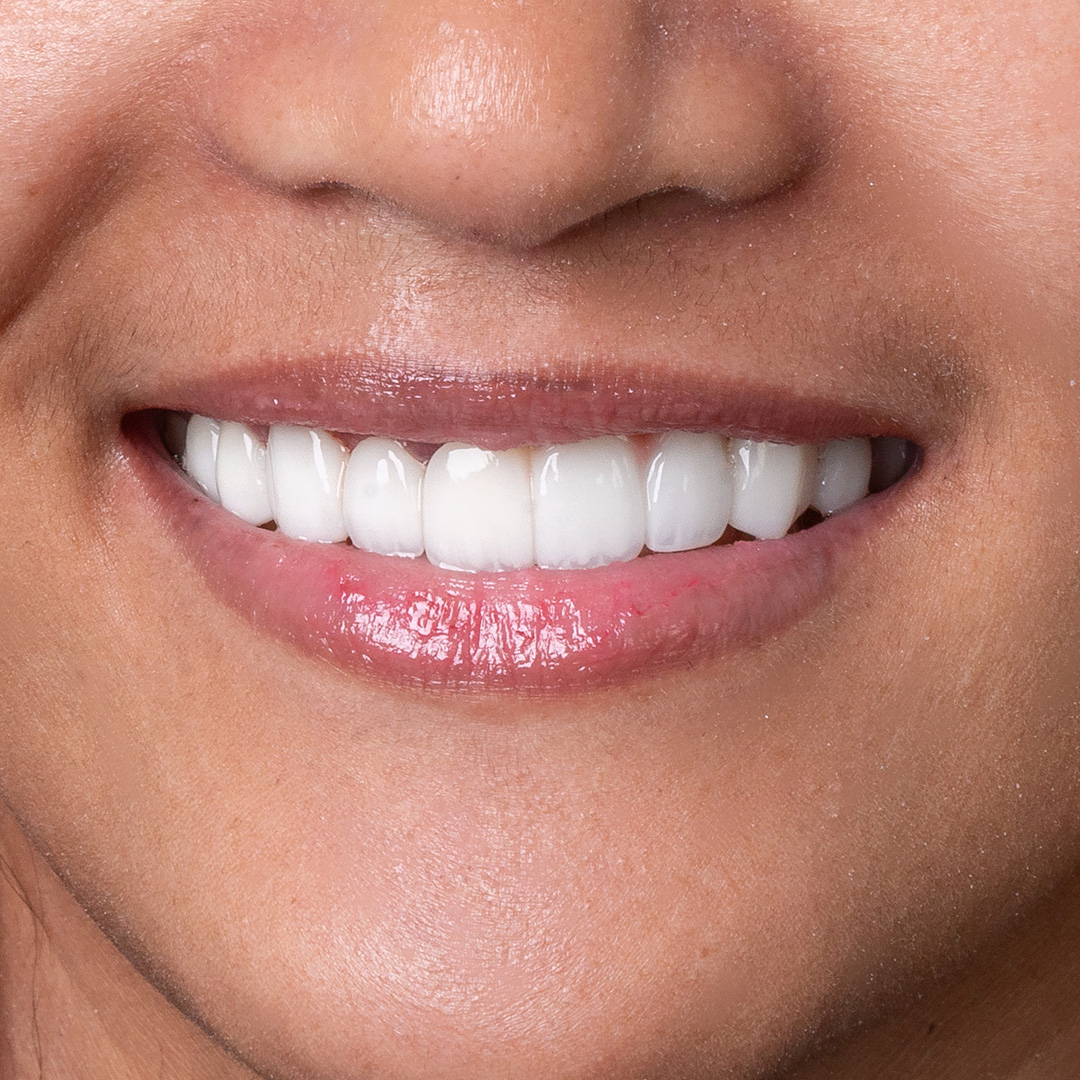 Close-up of natural-looking dental veneers by Vega Medical Center