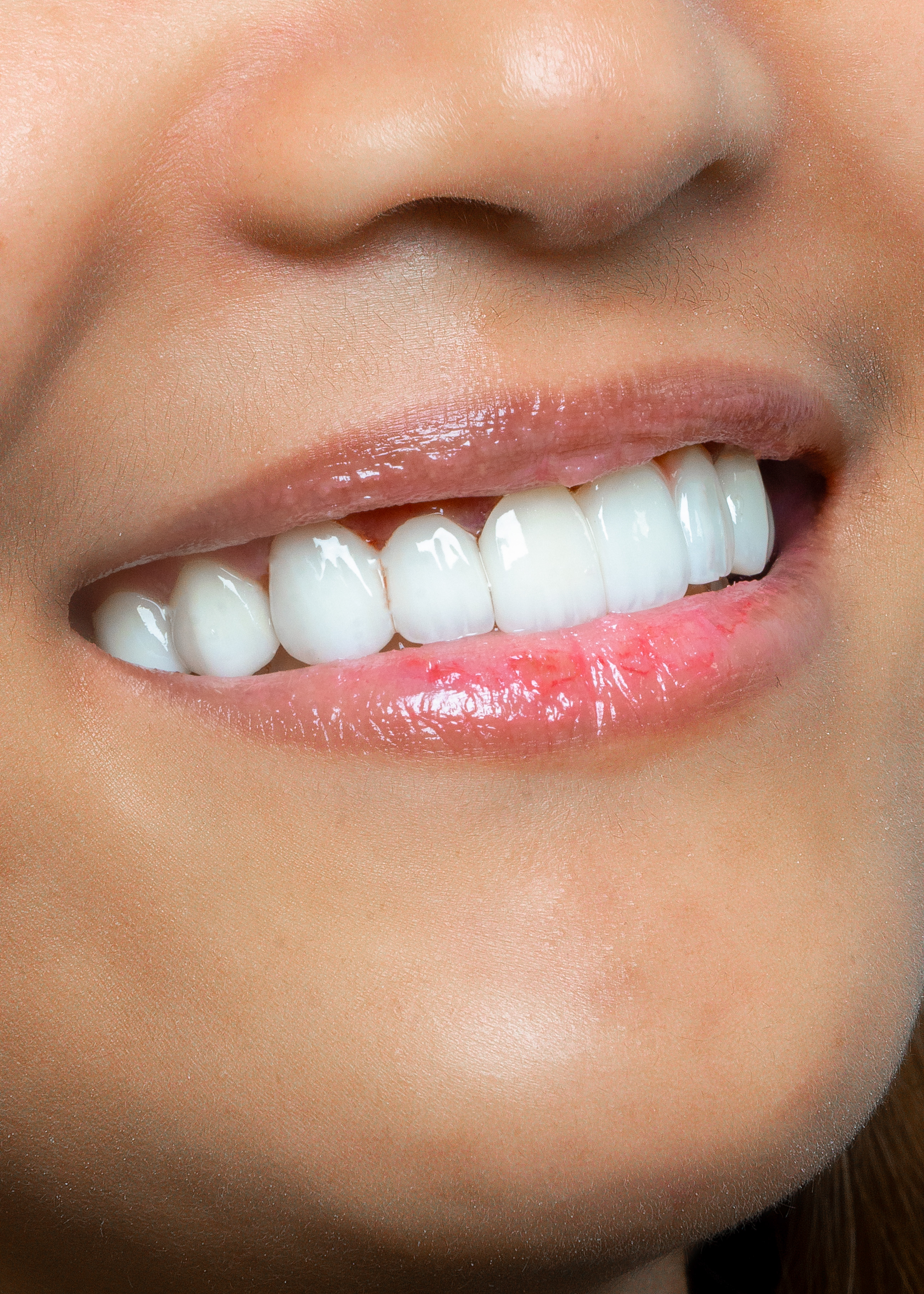 Close-up of natural-looking dental veneers by Vega Medical Center