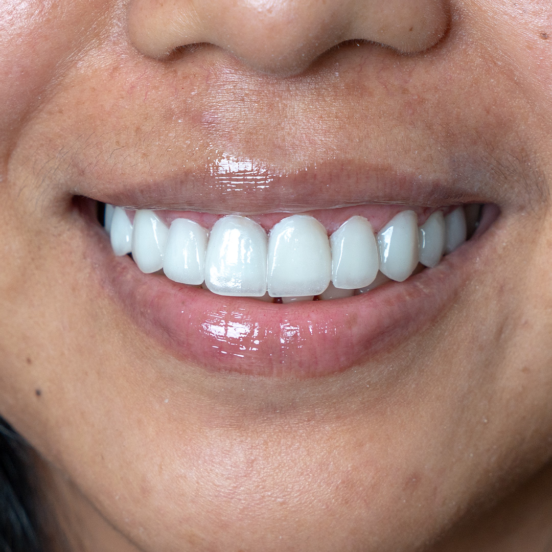 Close-up of natural-looking dental veneers by Vega Medical Center