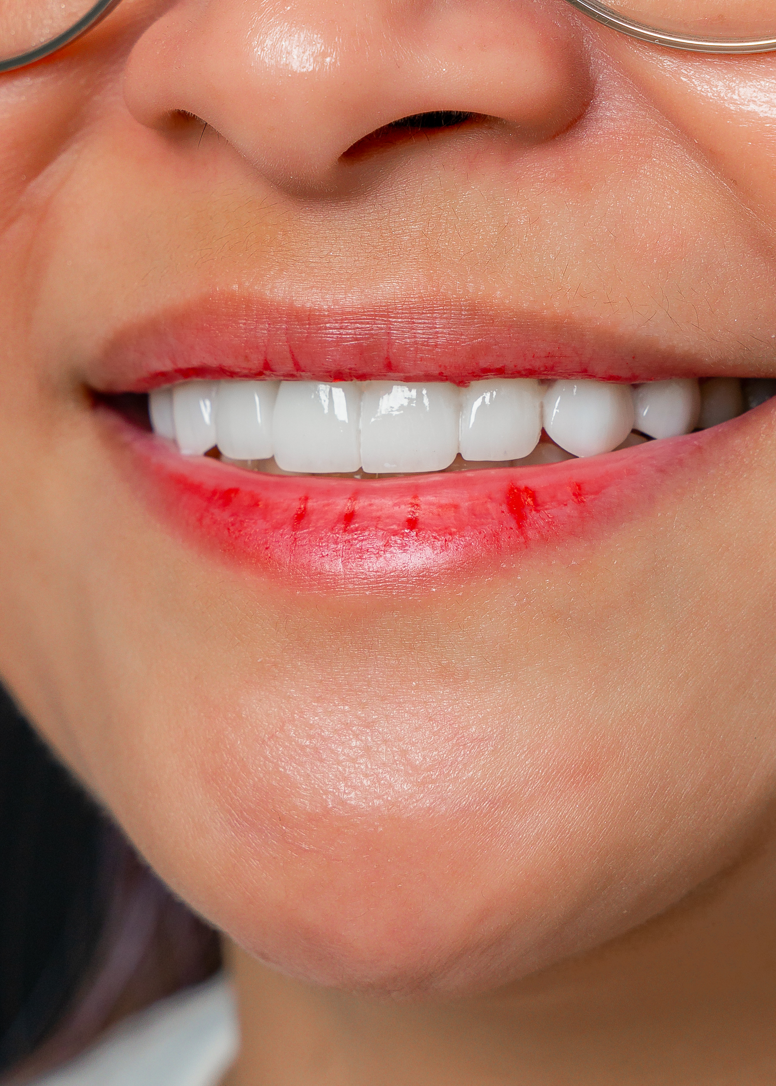 Close-up of natural-looking dental veneers by Vega Medical Center