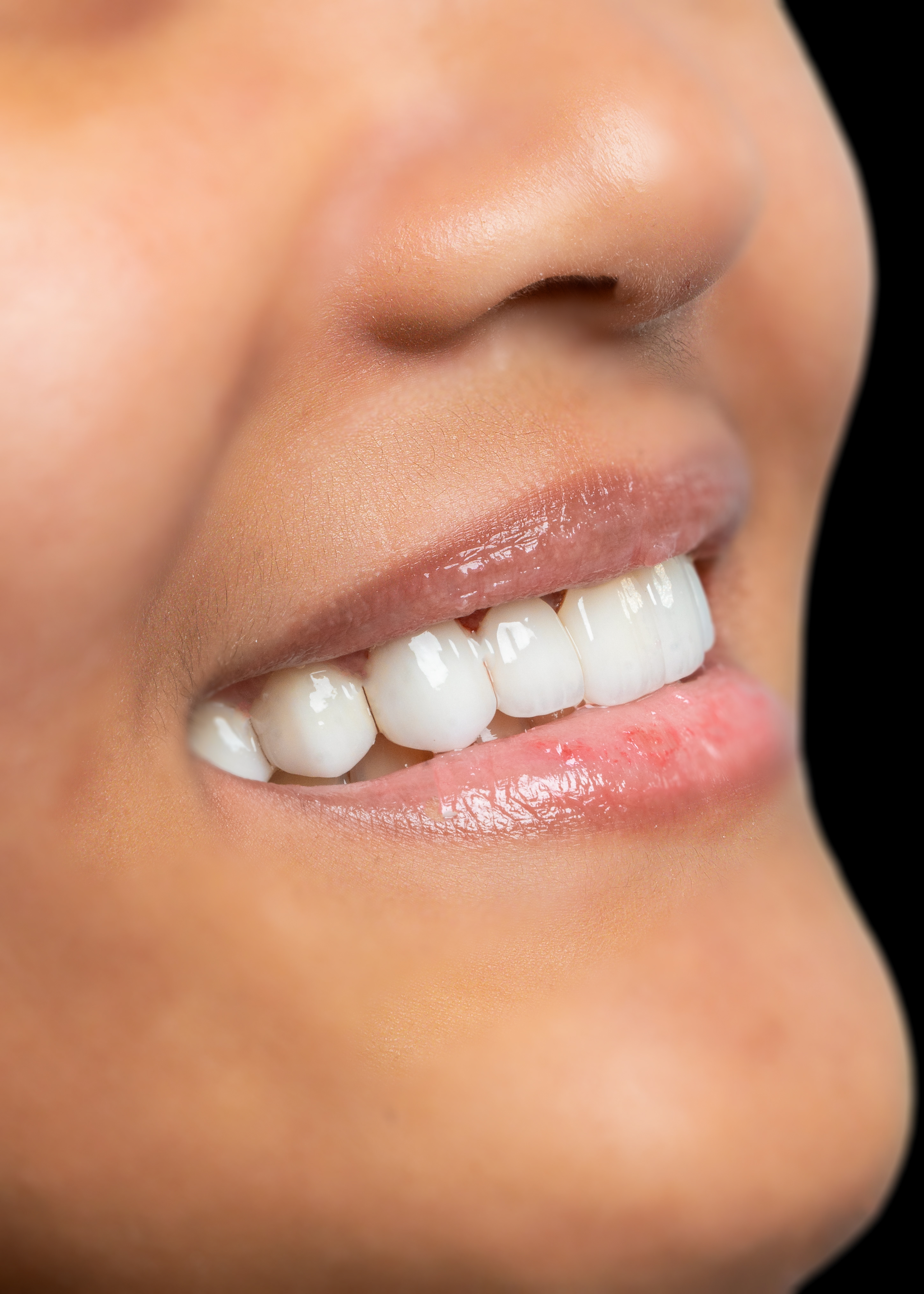 Close-up of natural-looking dental veneers by Vega Medical Center