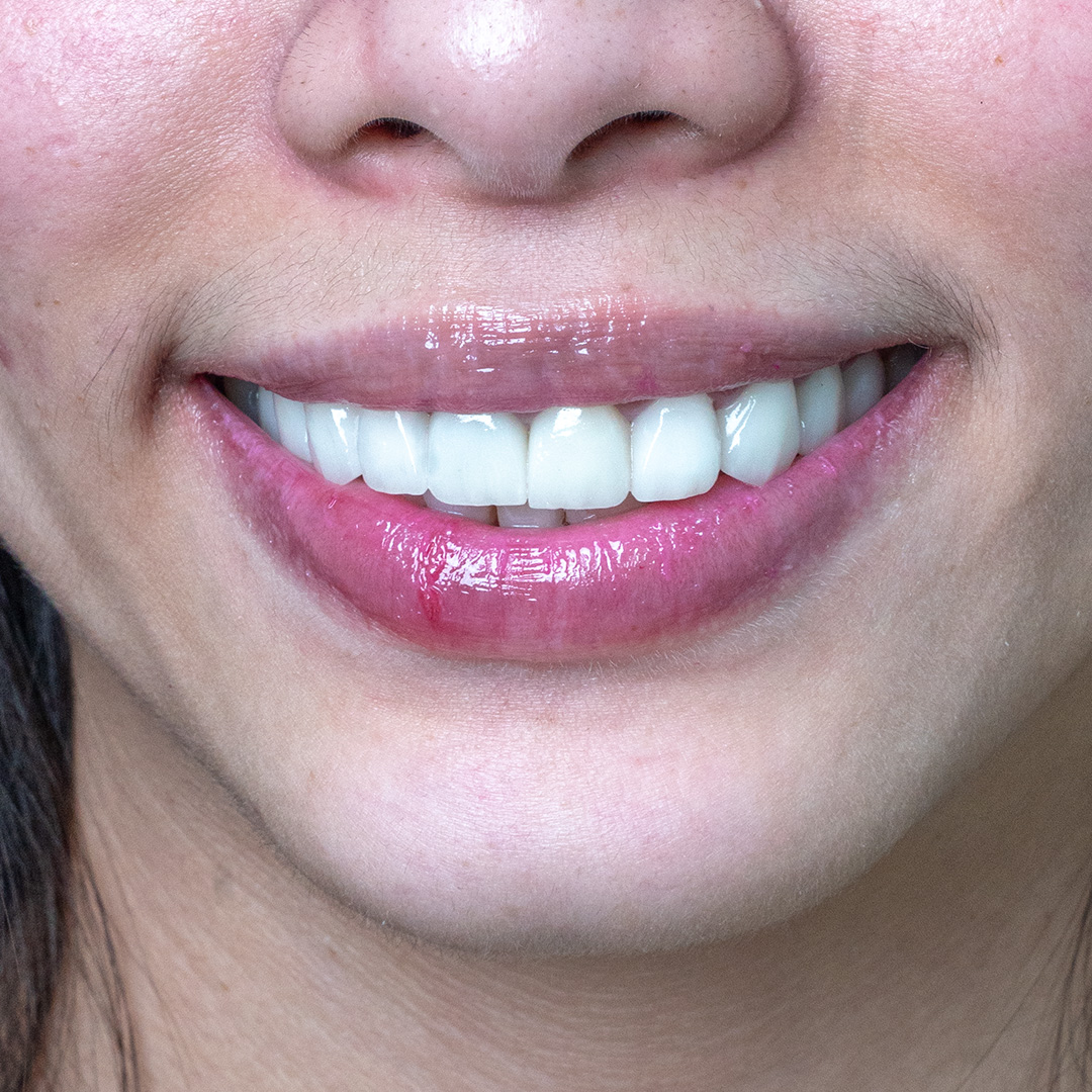 Close-up of natural-looking dental veneers by Vega Medical Center