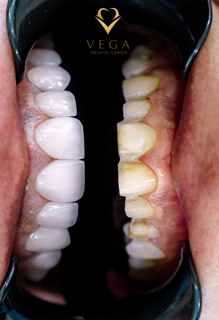 Close-up of natural-looking dental veneers by Vega Medical Center