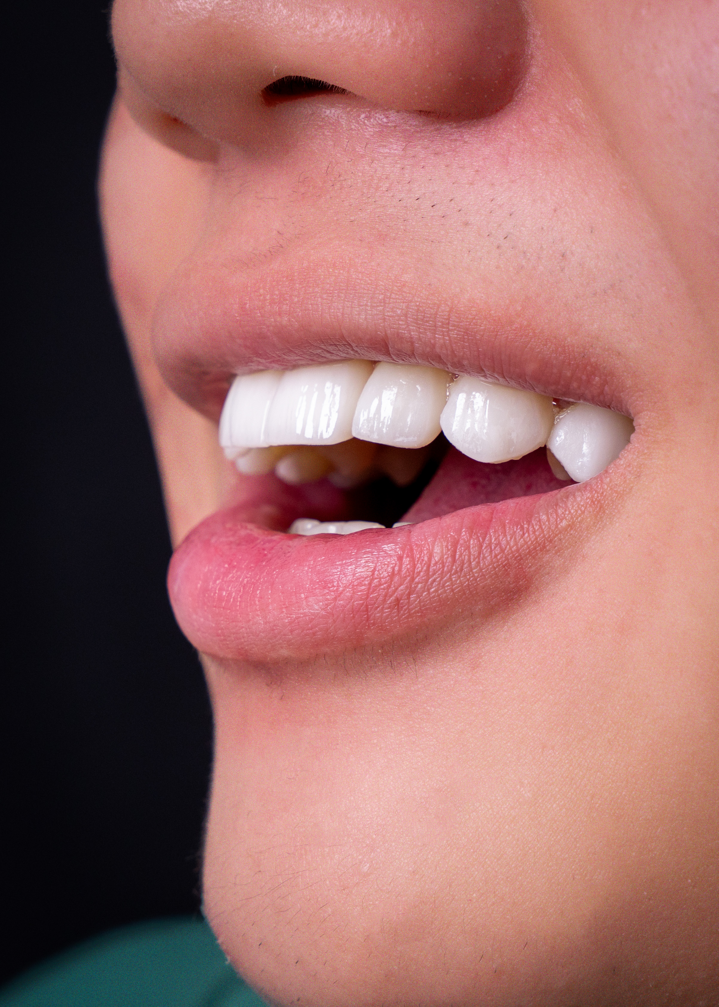 Close-up of natural-looking dental veneers by Vega Medical Center